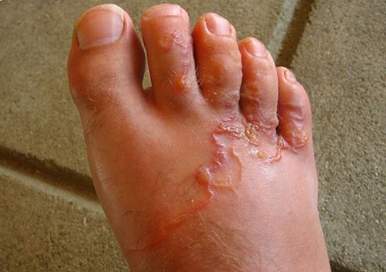 home remediesto get rid of hookworms in humans home remediesto get rid of hookworms in humans