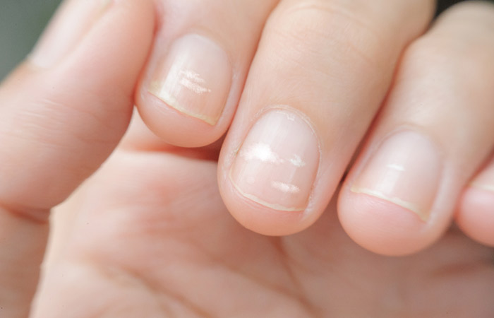 nail protein deficiency